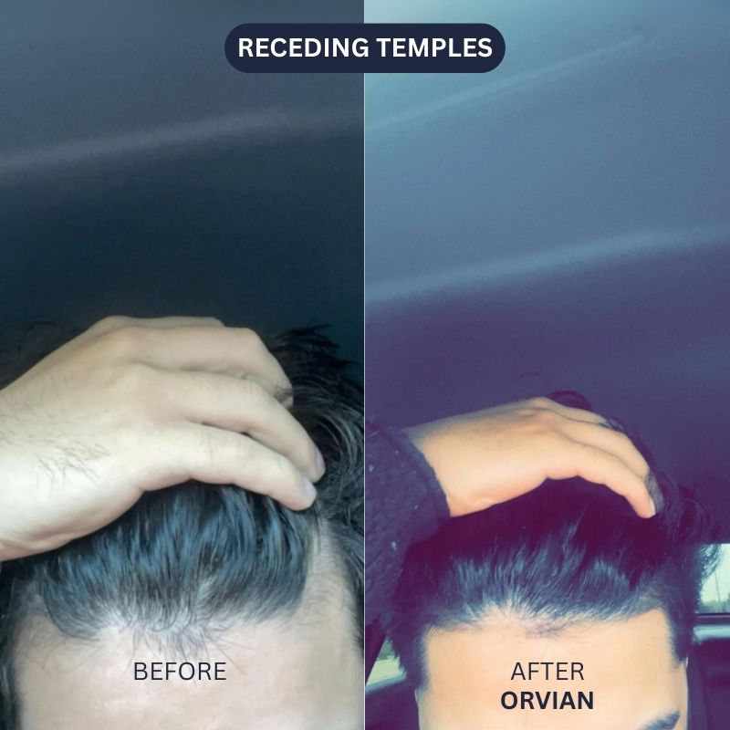 Hair Restoration Infusion System