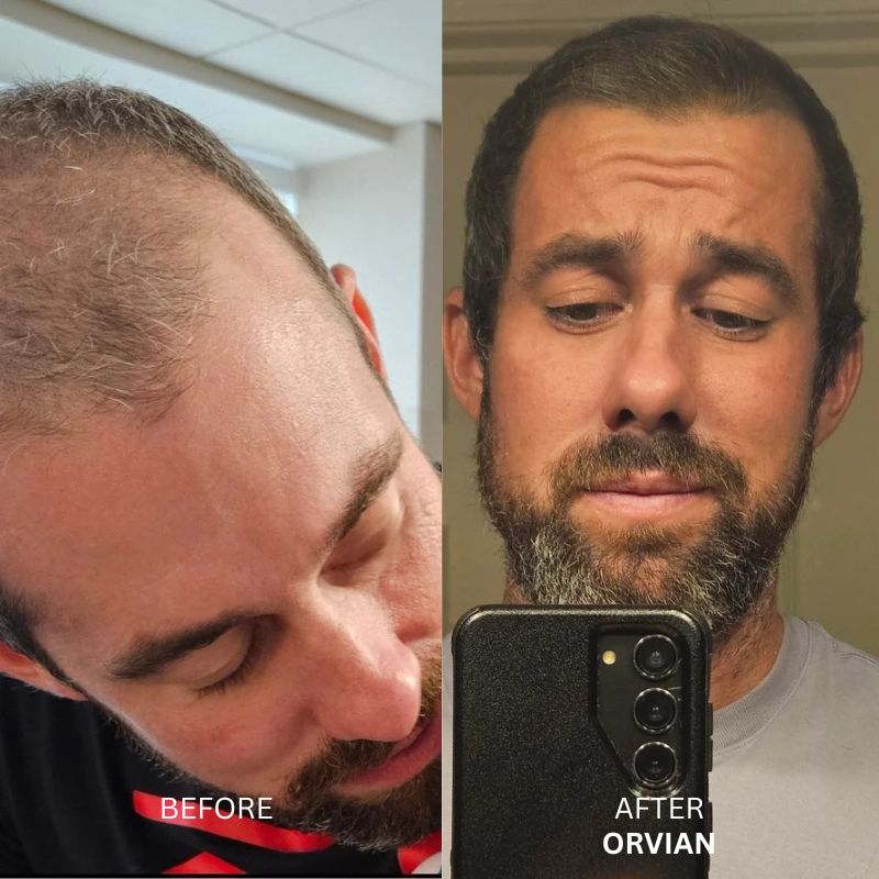 Hair Restoration Infusion System