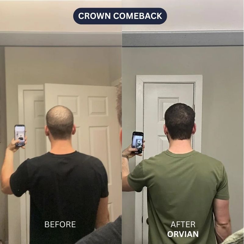 Hair Restoration Infusion System